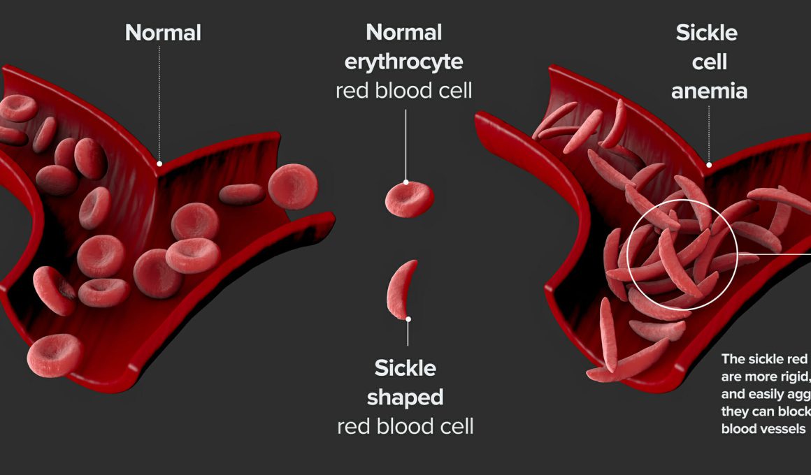 sickle cell