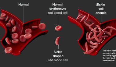 sickle cell