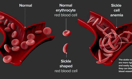 sickle cell